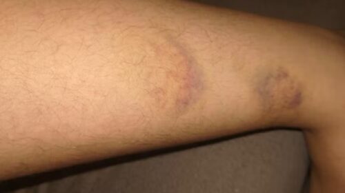 Fotografia que mostra braço com marcas roxas de agressão. Fim da descrição.